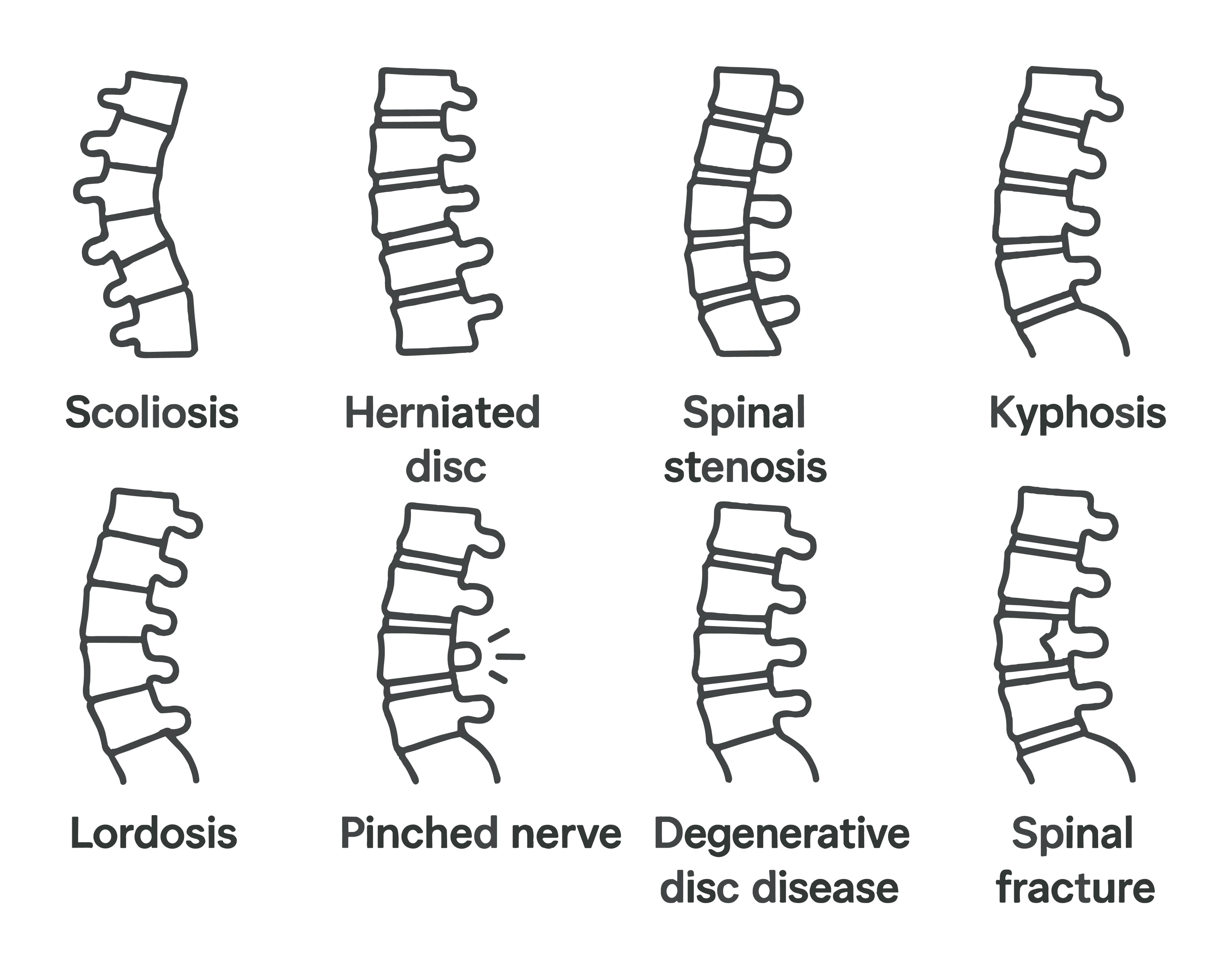 Spinal Disorders Treatment